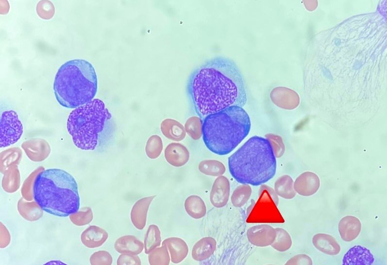 Zahra Sarrafan Chaharsoughi, MD (@zsarrafan) on Twitter photo Happy Friday from Hemepath Department <a href="/UTMB_Pathology/">UTMB Pathology</a>! 🤩
#hemepath #pathX
#Auer_rods
#AML Happy Friday from Hemepath Department <a href="/UTMB_Pathology/">UTMB Pathology</a>! 🤩
#hemepath #pathX
#Auer_rods
#AML