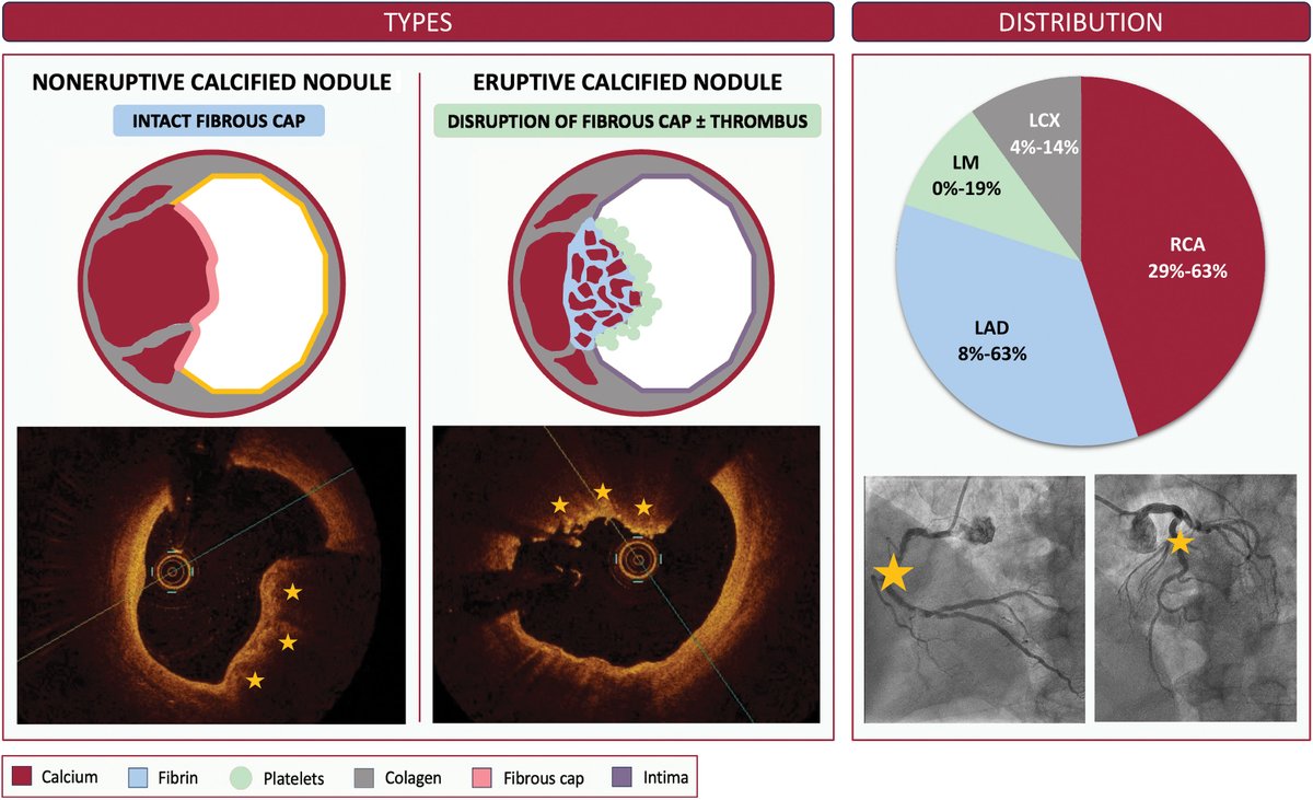 REC Publications (@revespcardiol) on Twitter photo Calcified nodules in the coronary arteries: systematic review on incidence and percutaneous coronary intervention outcomes #REC #Aheadofprint <a href="/ClaraFdezCordon/">Clara Fernández Cordón</a> <a href="/Sara_Blasco/">Sara Blasco Turrión</a> <a href="/ignamatsant/">Ignacio J. Amat</a> revespcardiol.org/en-calcified-n… Calcified nodules in the coronary arteries: systematic review on incidence and percutaneous coronary intervention outcomes #REC #Aheadofprint <a href="/ClaraFdezCordon/">Clara Fernández Cordón</a> <a href="/Sara_Blasco/">Sara Blasco Turrión</a> <a href="/ignamatsant/">Ignacio J. Amat</a> revespcardiol.org/en-calcified-n…