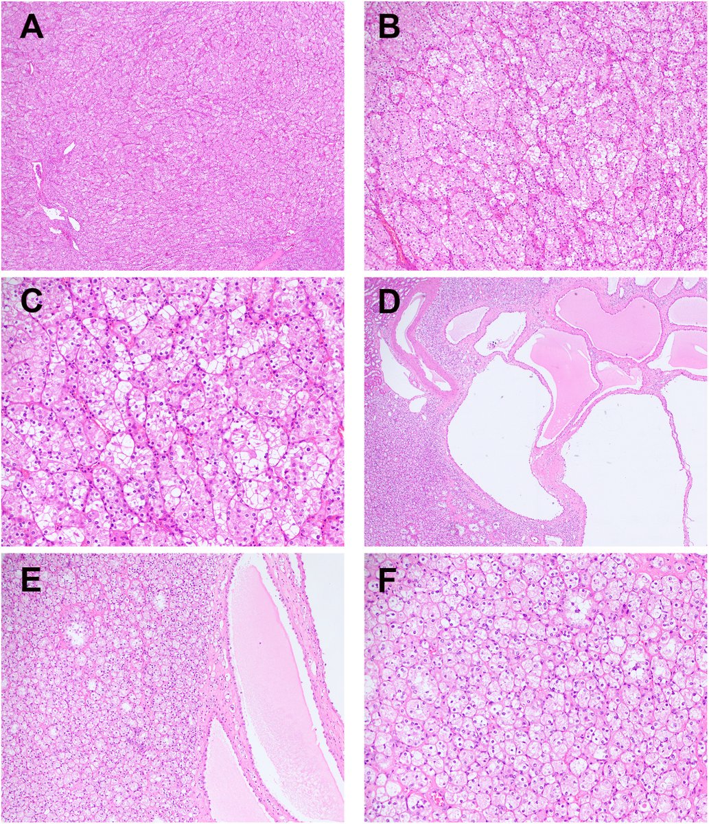 New in #HumPathol: Morphologic and Immunophenotypic Characterization of Conventional FLCN-Mutated Tumors (FMT) Compared to a Series of 8 Non-Conventional FMT. sciencedirect.com/science/articl… #pathology #PathTwitter #PathX #GUpath