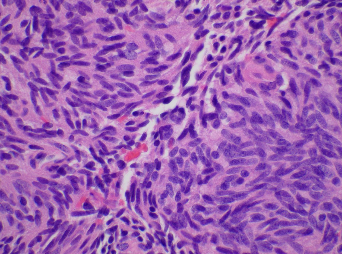 Mohammad Al-Attar (@mohdattar91) on Twitter photo A very spindly lung carcinoid! (smears and cell block)
#cytopathology A very spindly lung carcinoid! (smears and cell block)
#cytopathology