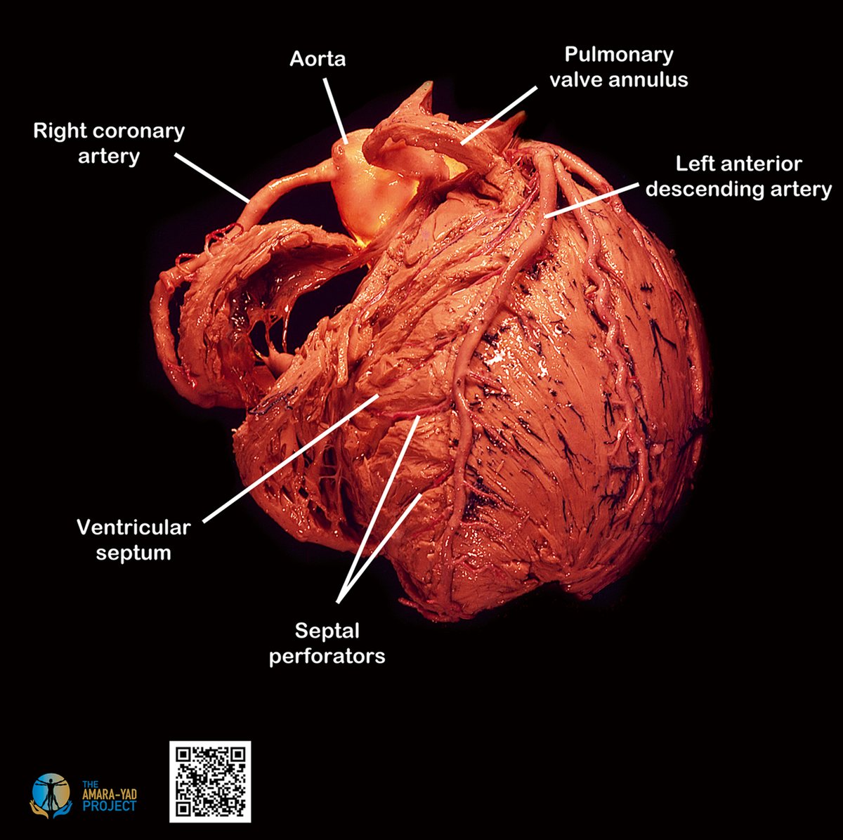 JACC Journals (@jaccjournals) on Twitter photo Visualize the beauty of the heart 🫀: This left anterior oblique view shows septal perforators like you’ve never seen them. The art of precision lives here 🎨 jacc.org/doi/10.1016/j.…
#CathLab #JACC #Cardiology #AnatomyNerds <a href="/shivkumarmd/">Kalyanam Shivkumar MD PhD</a> Visualize the beauty of the heart 🫀: This left anterior oblique view shows septal perforators like you’ve never seen them. The art of precision lives here 🎨 jacc.org/doi/10.1016/j.…
#CathLab #JACC #Cardiology #AnatomyNerds <a href="/shivkumarmd/">Kalyanam Shivkumar MD PhD</a>