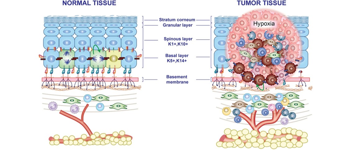 Dermal Cell News (@dermalcell) on Twitter photo .<a href="/TaipeiMedicalU/">Taipei Medical University</a> researchers explore advances in understanding how niche factors regulate cell fate determination between skin stem cells and #SkinCancer stem cells, along with their clinical implications.
💡 bit.ly/4kskpLn .<a href="/TaipeiMedicalU/">Taipei Medical University</a> researchers explore advances in understanding how niche factors regulate cell fate determination between skin stem cells and #SkinCancer stem cells, along with their clinical implications.
💡 bit.ly/4kskpLn