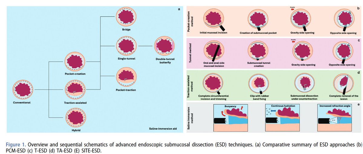 Daryl Ramai, MD, MPH, MSc. (@darylramai) on Twitter photo Happy to share our latest review on ESD 🔪techniques.
A tailored and integrated approach based on lesion location and characteristics is essential for optimizing outcomes #ESD #GITwitter #endoscopy <a href="/calabrocolo_txt/">Giulio Calabrese</a> <a href="/MarcelloMaida/">Marcello Maida</a> <a href="/sandrosferrazz1/">Sandro Sferrazza</a>
👉…-nlm-nih-gov.proxy3.library.mcgill.ca/40396271/ Happy to share our latest review on ESD 🔪techniques.
A tailored and integrated approach based on lesion location and characteristics is essential for optimizing outcomes #ESD #GITwitter #endoscopy <a href="/calabrocolo_txt/">Giulio Calabrese</a> <a href="/MarcelloMaida/">Marcello Maida</a> <a href="/sandrosferrazz1/">Sandro Sferrazza</a>
👉…-nlm-nih-gov.proxy3.library.mcgill.ca/40396271/