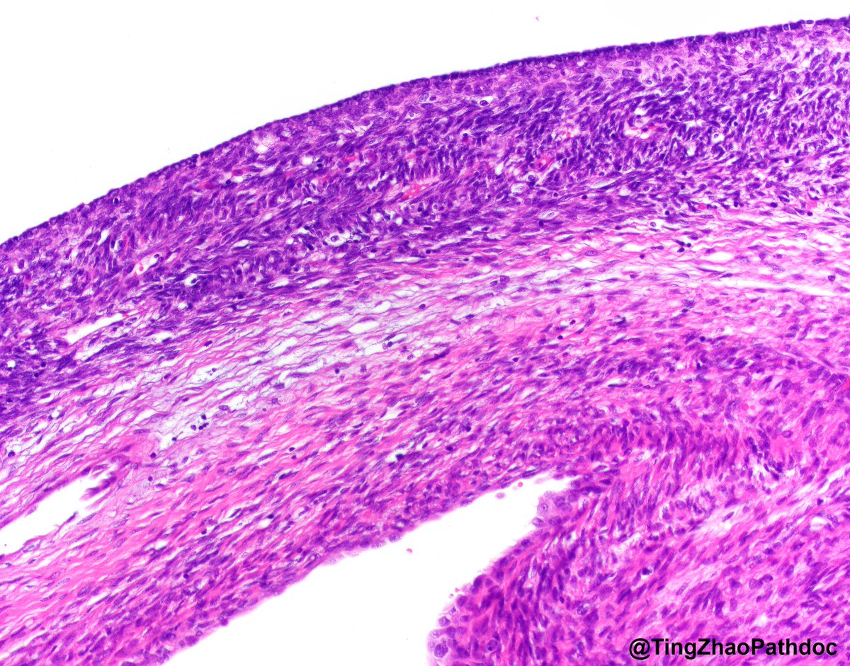 Ting Zhao, MD (@tingzhaopathdoc) on Twitter photo 50 y.o. F, radical nephrectomy. What is your diagnosis? Gross photo in the chat.
#PathTwitter
<a href="/MGBpathology/">Mass General Brigham Pathology</a> <a href="/MGHPathology/">MGH Pathology</a> 50 y.o. F, radical nephrectomy. What is your diagnosis? Gross photo in the chat.
#PathTwitter
<a href="/MGBpathology/">Mass General Brigham Pathology</a> <a href="/MGHPathology/">MGH Pathology</a>