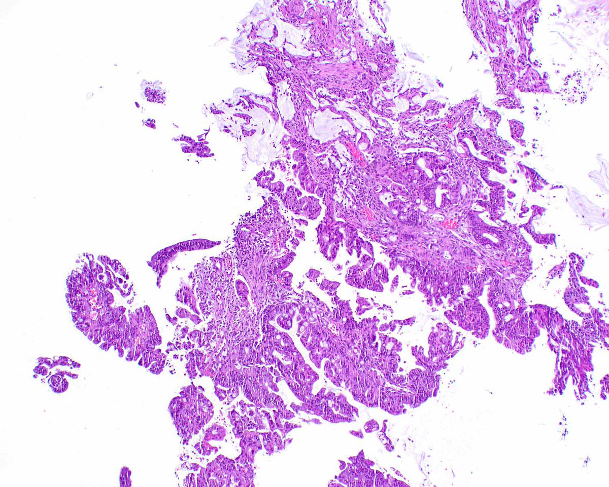 ModernPathology's tweet image. SMAD4/DPC4 nuclear loss on immunohistochemistry can support an interpretation of pancreatic ductal adenocarcinoma even when there is signet ring cell morphology (this example is more typical).
Simbolo M, et al. Clinical and Genomic Characterization of Pancreatic Ductal…