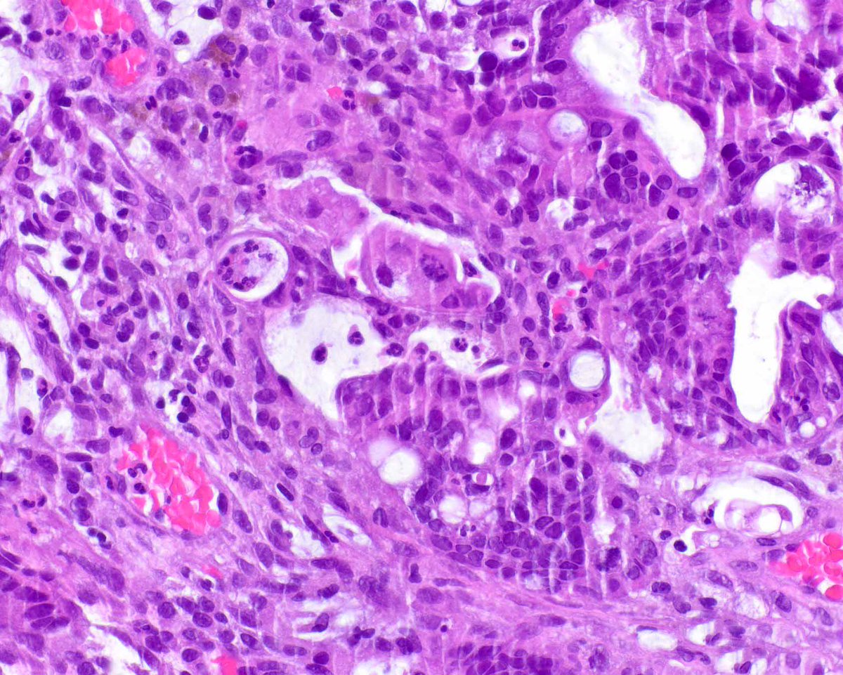 ModernPathology's tweet image. SMAD4/DPC4 nuclear loss on immunohistochemistry can support an interpretation of pancreatic ductal adenocarcinoma even when there is signet ring cell morphology (this example is more typical).
Simbolo M, et al. Clinical and Genomic Characterization of Pancreatic Ductal…
