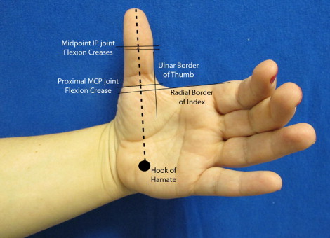 🛑 Awareness of the topographical landmarks in localizing A1 pulley &amp; digital neurovascular structures, improve safety &amp; efficacy of the Trigger Thumb (stenosing tenosynovitis) treatment.

It's caused by a size mismatch between flexor tendon &amp; A1 pulley
doi.org/10.1016/j.jhsa…