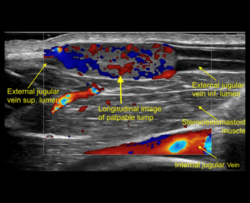 ASA (@asasonography) on Twitter photo đ This Sonography case report presents a histologically confirmed intravenous pyogenic granuloma identified by ultrasound in the right external jugular vein. #SupportingSonographers <a href="/WileyHealth/">Wiley Clinical Health</a>
loom.ly/I3A2C14 đ This Sonography case report presents a histologically confirmed intravenous pyogenic granuloma identified by ultrasound in the right external jugular vein. #SupportingSonographers <a href="/WileyHealth/">Wiley Clinical Health</a>
loom.ly/I3A2C14