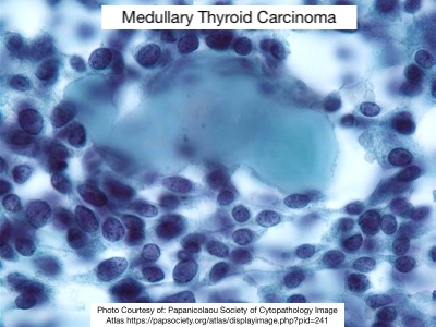 Post Day 1 after AP/CP Boards, 😮‍💨 

⚪️   Let's talk Medullary Thyroid Carcinoma 

🧬 Ass w MEN2a and MEN2b syndrome
🧬 Due to RET mutation
🔬 I find the Calcitonin amyloid it produces tricky as it looks like good ole colloid! ⬇️ 

#pathx #cytopath #ent #hemeonc #thyroidcancer