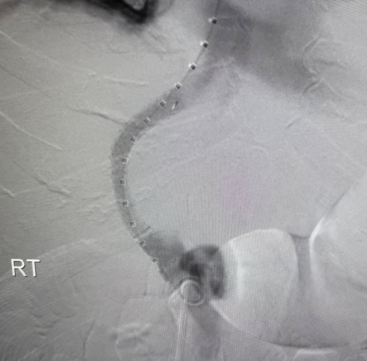 Harris Chengazi (@chengazimd) on Twitter photo What better way to start holiday weekend call than a TIPS PR
Bleeding tips:
22 mins from lido to pressure, single stick w/ #ScorpionX
Gradient 27>8mmHg, 8cm Viatorr
#ICETIPS <a href="/WLGore/">Gore</a> <a href="/ArgonMedical/">Argon Medical</a>
Props again to <a href="/tarheeldylan/">Dylan</a> and <a href="/_backtable/">BackTable Vascular and Interventional</a> (episode 455 for basic technique) What better way to start holiday weekend call than a TIPS PR
Bleeding tips:
22 mins from lido to pressure, single stick w/ #ScorpionX
Gradient 27>8mmHg, 8cm Viatorr
#ICETIPS <a href="/WLGore/">Gore</a> <a href="/ArgonMedical/">Argon Medical</a>
Props again to <a href="/tarheeldylan/">Dylan</a> and <a href="/_backtable/">BackTable Vascular and Interventional</a> (episode 455 for basic technique)