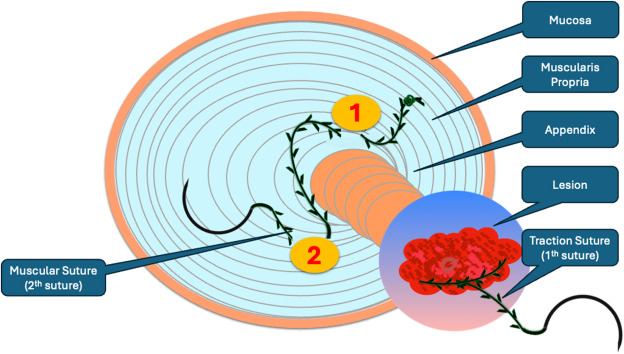 VideoGIE Editor's Choice: “Transcecal endoscopic appendectomy and endoscopic submucosal dissection with hand-suturing–assisted traction and closure technique" by Fatih Aslan et al. videogie.org/article/S2468-…

#GITwitter