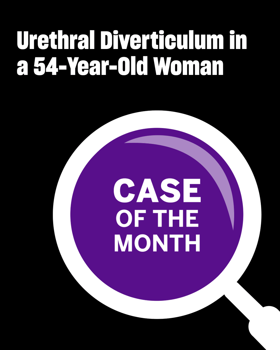 NYU Grossman School of Medicine (@nyugrossman) on Twitter photo An asymptomatic 54-year-old woman was diagnosed with a 2.1 cm urethral diverticulum on MRI. Despite no symptoms, she opted for surgery to prevent future complications. Outcome: full recovery with continence preserved.
 Read more: bit.ly/4jets0Z An asymptomatic 54-year-old woman was diagnosed with a 2.1 cm urethral diverticulum on MRI. Despite no symptoms, she opted for surgery to prevent future complications. Outcome: full recovery with continence preserved.
 Read more: bit.ly/4jets0Z