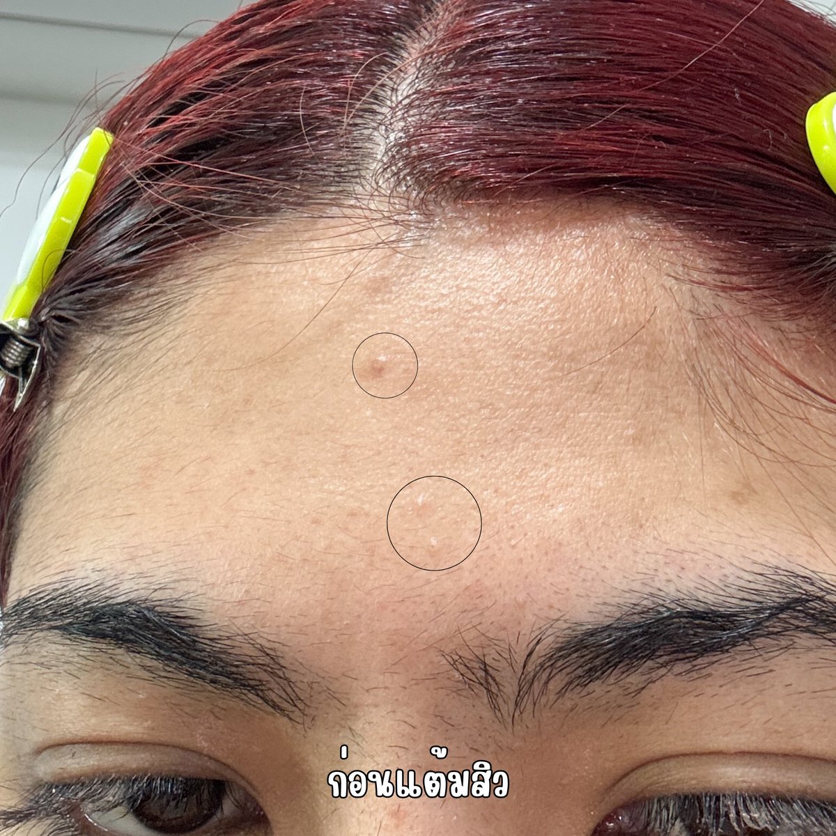 NBofficial8's tweet photo. 📍#pharmular ชีเสิร์ฟมาก ตามมาจากคุณชินใช้แล้วโคตรดี! ใช้ได้หมดทุกสิว เม็ดเล็ก เม็ดใหญ่เอาอยู่หมด แต้มคืนเดียวสิวหลุดออกมาเลยไวทันใจ555สิวไม่ขึ้นซ้ำ ไม่แสบ ไม่คัน ไม่ยิบๆผิว ผิวแพ้ง่ายใช้ได้ชอบที่แต้มทับเมคอัพได้ กดหลอดนี้มาในช้อปปี้ไม่ถึง 200 ราคาน่ารักสุด #ฟาร์มูล่า #เจลแต้มสิว https://t.co/apMIj9zXV7
