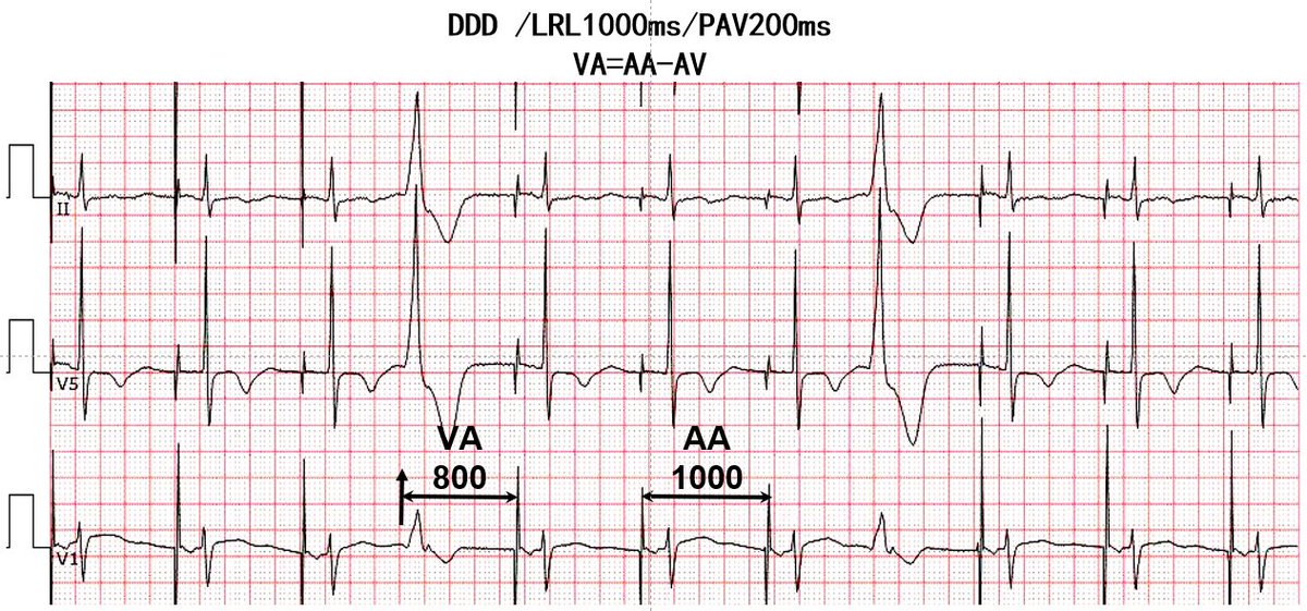 Improved atrial pacing or ventricular pacing