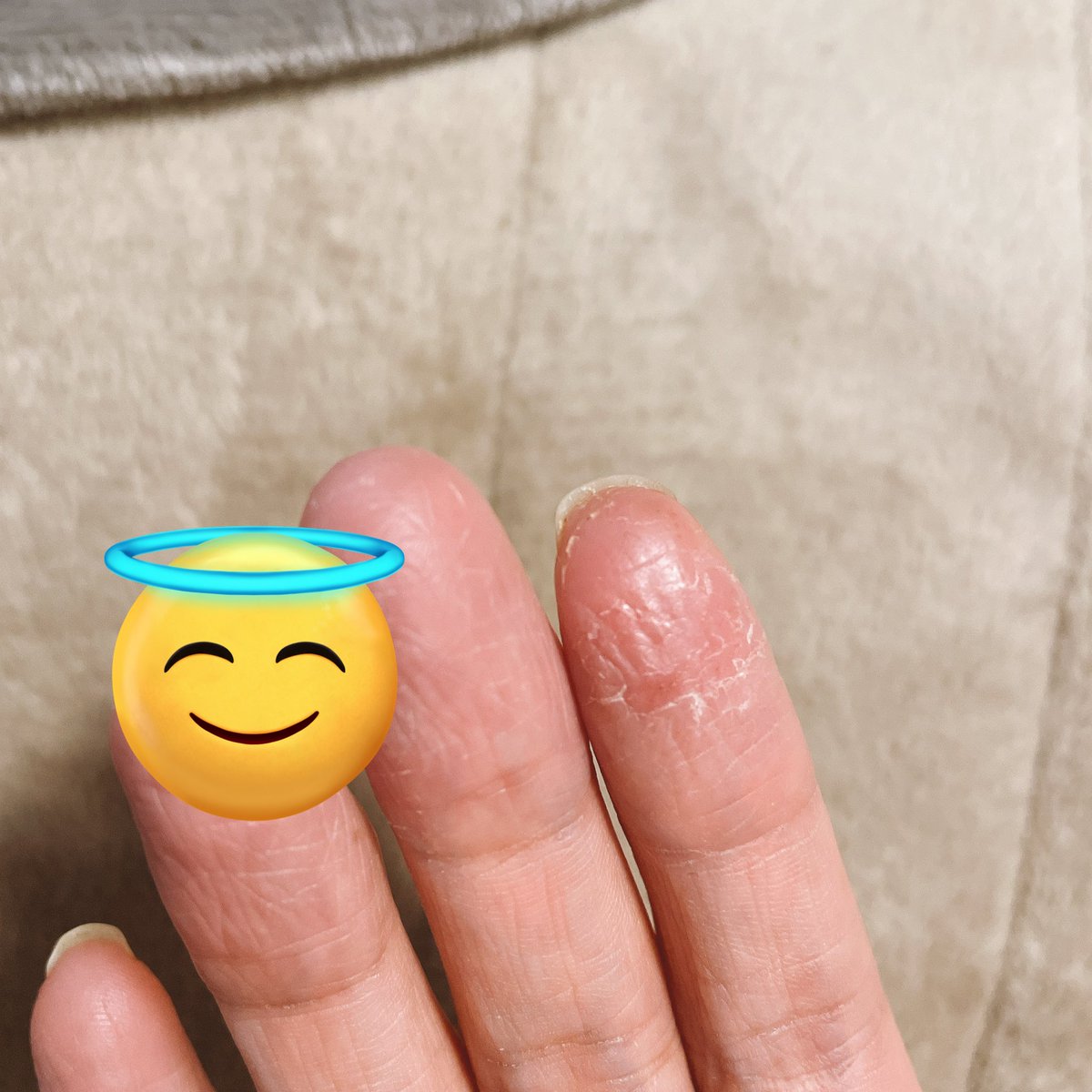 指切って絆創膏貼ってたらやっぱりかぶれて皮剥けた