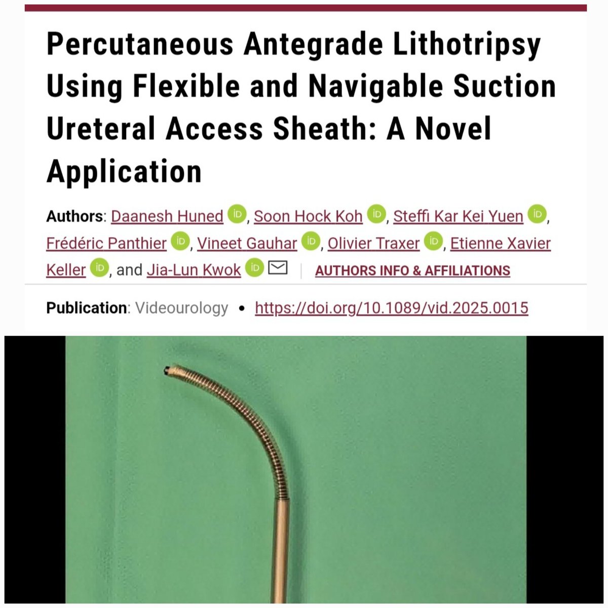 Jia-Lun Kwok (@jl_kwok) on Twitter photo #suction #FANS Percutaneous antegrade approach for large, impacted, upper ureteral stone
🔗liebertpub.com/doi/10.1089/vi… + #FANS & p-Tm:YAG #thulio
<a href="/steffiyuen/">Steffi Yuen</a> <a href="/DocGauhar/">DrG</a> <a href="/exkeller/">Etienne Xavier Keller</a> <a href="/OTRAXER/">Olivier Traxer</a> <a href="/PEARLSendouro/">PEARLS</a> <a href="/Shkohsg/">Soon Hock Koh</a> #fpanthier
#EAUendourology <a href="/asiaendouro/">AUSET</a> <a href="/YAUEndourology/">YAU ENDOUROLOGY</a> <a href="/PETRAurogroup/">PETRA</a> #suction #FANS Percutaneous antegrade approach for large, impacted, upper ureteral stone
🔗liebertpub.com/doi/10.1089/vi… + #FANS & p-Tm:YAG #thulio
<a href="/steffiyuen/">Steffi Yuen</a> <a href="/DocGauhar/">DrG</a> <a href="/exkeller/">Etienne Xavier Keller</a> <a href="/OTRAXER/">Olivier Traxer</a> <a href="/PEARLSendouro/">PEARLS</a> <a href="/Shkohsg/">Soon Hock Koh</a> #fpanthier
#EAUendourology <a href="/asiaendouro/">AUSET</a> <a href="/YAUEndourology/">YAU ENDOUROLOGY</a> <a href="/PETRAurogroup/">PETRA</a>