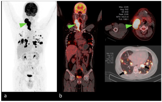 JCM MDPI (@jcm_mdpi) on Twitter photo #mdpijcm
#Feature_Paper
Comprehensive Review of the Imaging Recommendations for Diagnosis, Staging, and Management of #ThyroidCarcinoma
by Nivedita Chakrabarty et al. @DrNivedita <a href="/AMCancerImaging/">Abhishek Mahajan</a>
<a href="/MediPharma_MDPI/">MDPI Medicine & Pharmacology</a>
👉mdpi.com/2788976 #mdpijcm
#Feature_Paper
Comprehensive Review of the Imaging Recommendations for Diagnosis, Staging, and Management of #ThyroidCarcinoma
by Nivedita Chakrabarty et al. @DrNivedita <a href="/AMCancerImaging/">Abhishek Mahajan</a>
<a href="/MediPharma_MDPI/">MDPI Medicine & Pharmacology</a>
👉mdpi.com/2788976