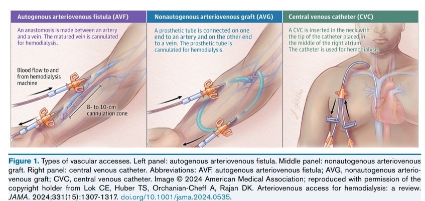 Acceso Vascular en Hemodiálisis 🩸🫘

🔰📚Am J Kidney Dis. 2024

doi: 10.1053/
j.ajkd.2024.05.021

Enlace a Artículo Completo 👇🏼✅🆓t.me/SoMELaguna