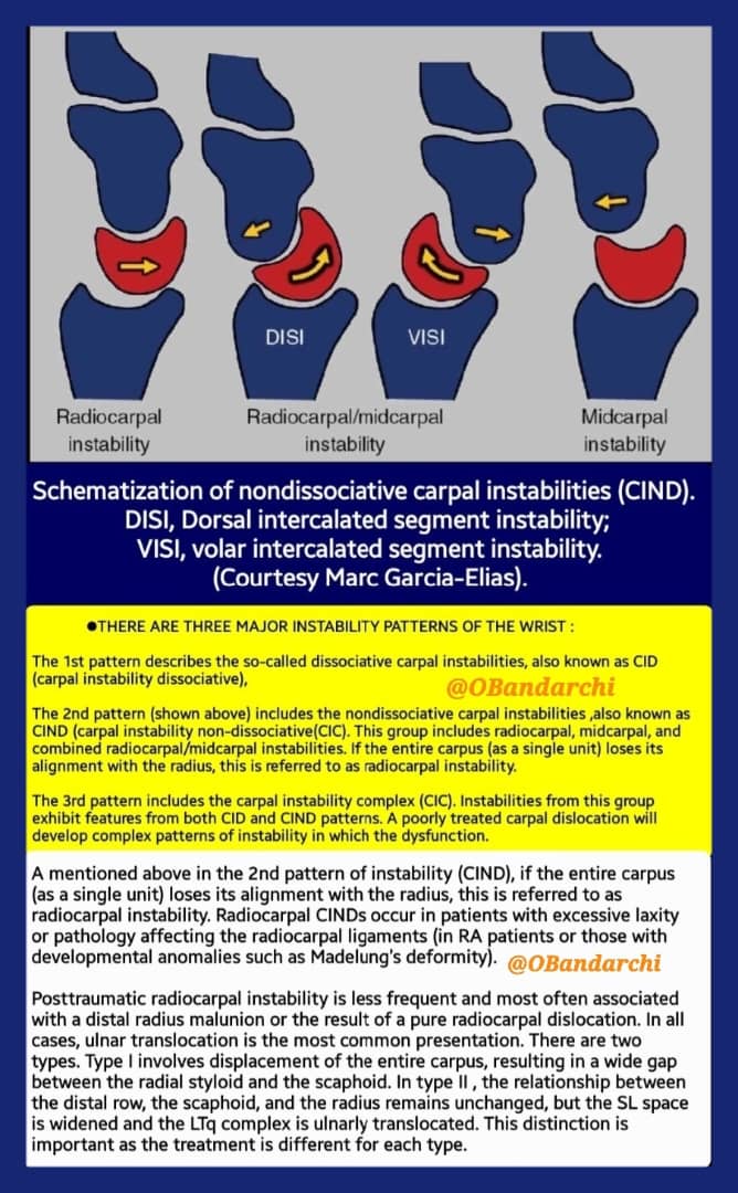 🛑Wrist is a complex joint comprising 15 bones, 24 joint facets and 24 ligaments.Furthermore it incorporates a system of 8 pulleys to control the moment arms of 24 tendons that cross the joint.

-Carpal instability is also complex. Here the 2nd pattern of carpal instability shown