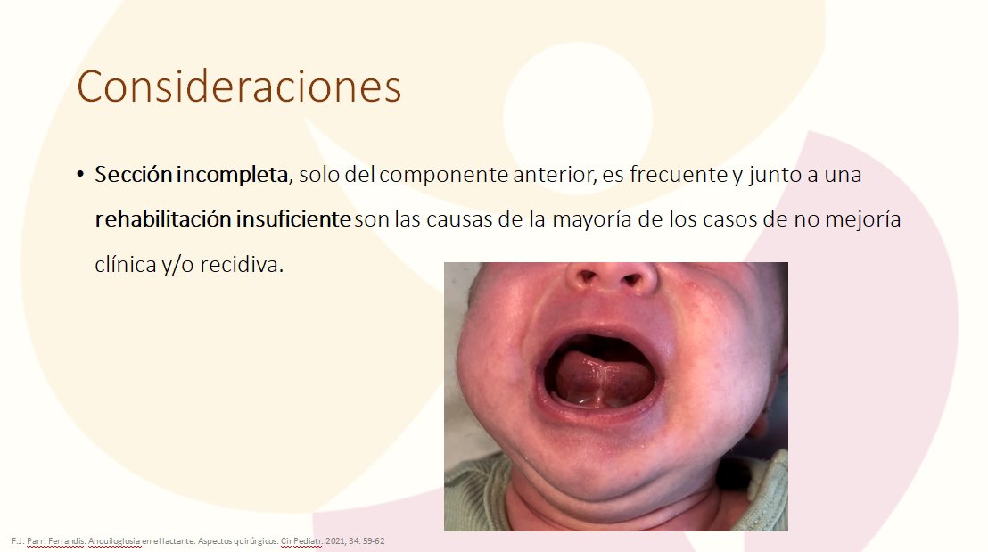 Anquiloglosia: Plan de tratamiento (Dra.Cristina Marès) #grindope2025