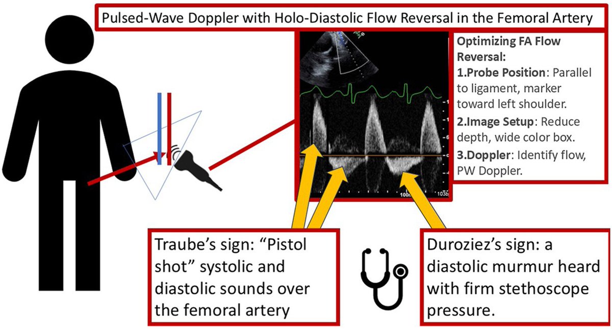 V.L.Sorrell, MD (@CASEfromASE EIC) (@vlsorrellimages) on Twitter photo #JADEL
Just In CASE <a href="/CASEfromASE/">CV Case Journal</a>:
Expanding our Physical Exam Skills through POCUS:
doi.org/10.1016/j.case…
"Femoral artery Doppler complements an integrated approach for the assessment of AR"
<a href="/ASE360/">American Society of Echocardiography</a> #JADEL
Just In CASE <a href="/CASEfromASE/">CV Case Journal</a>:
Expanding our Physical Exam Skills through POCUS:
doi.org/10.1016/j.case…
"Femoral artery Doppler complements an integrated approach for the assessment of AR"
<a href="/ASE360/">American Society of Echocardiography</a>