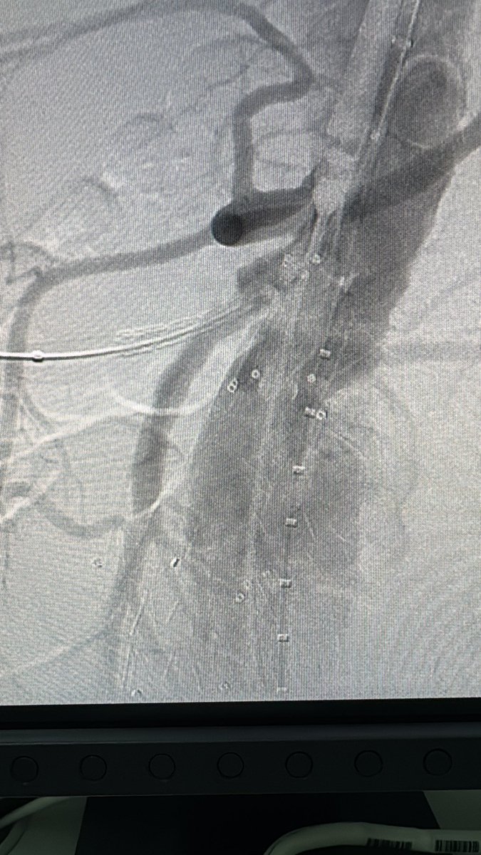 GenivalVid98027's tweet photo. Aorto Caval Fistula plus AAA and iliacs!!
@AortaSurg @PenseAorta @AortaEd @THINK__AORTA @walter_boim @VascularForum @PipeCabreraV @Dr_Ma_of_PUMC @Lazybonesradio1 @CelestinoGutirr @OckeReis @cvirendo @UMNVascularSurg @UK_Aorta @CleClinicHVTI @GAEscobarMD @ErbenYoung https://t.co/JgahG24hAr