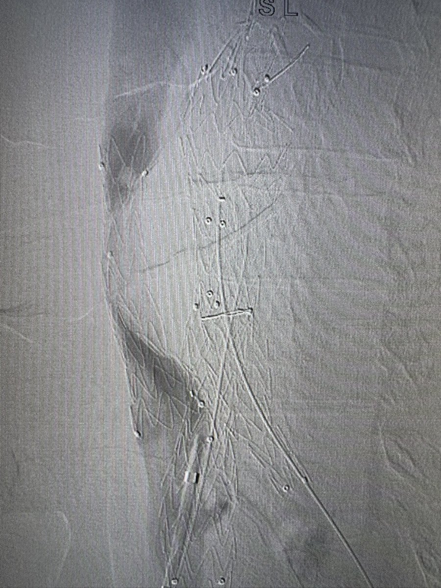 GenivalVid98027's tweet photo. Aorto Caval Fistula plus AAA and iliacs!!
@AortaSurg @PenseAorta @AortaEd @THINK__AORTA @walter_boim @VascularForum @PipeCabreraV @Dr_Ma_of_PUMC @Lazybonesradio1 @CelestinoGutirr @OckeReis @cvirendo @UMNVascularSurg @UK_Aorta @CleClinicHVTI @GAEscobarMD @ErbenYoung https://t.co/JgahG24hAr