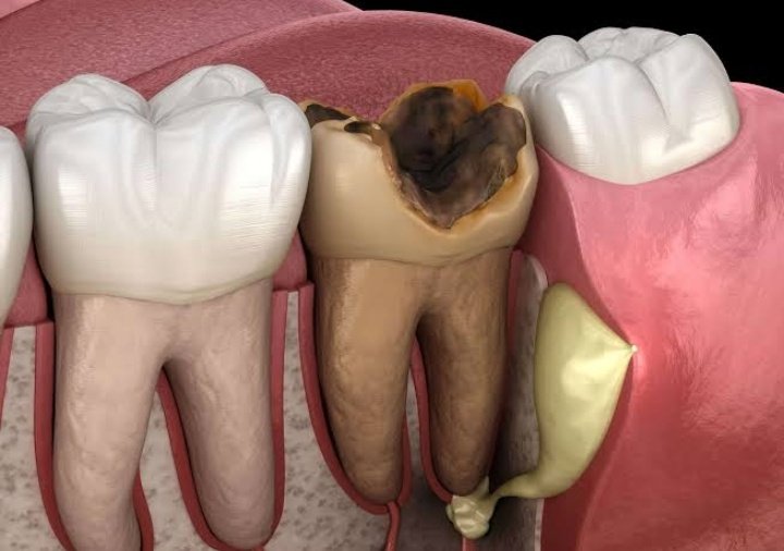 🚨Repost for someone: 

✍️Brushing your teeth in the evening is more important

✍️When you have a tooth hole, it is not always a good idea to remove it.

✍️Frequently taking coffee stains your white faster

✍️Brushing before taking water in the morning is not healthy for your gut