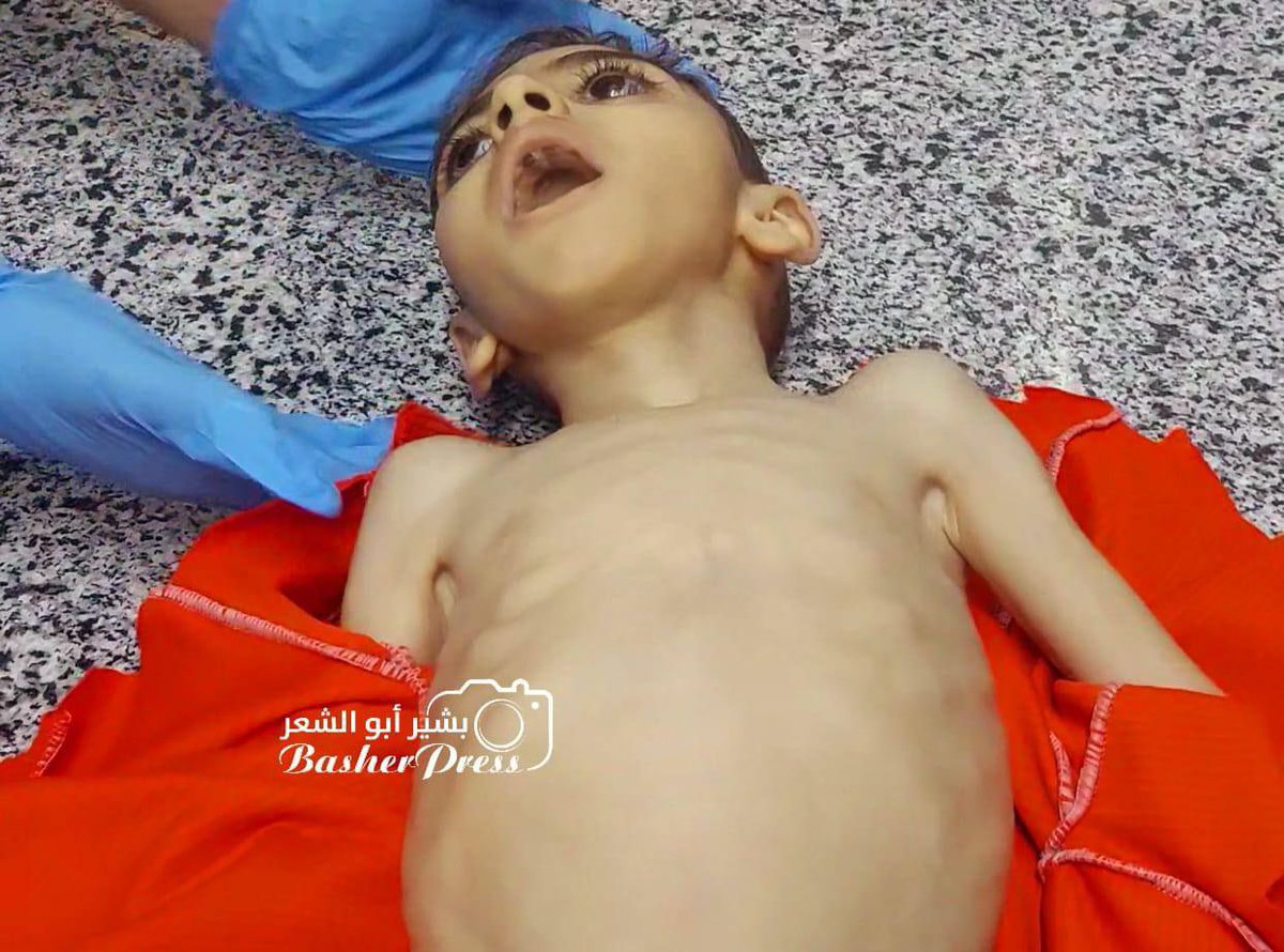 HalaAbouHassira's tweet photo. Mohammed Yassine (5 ans) est décédé aujourd’hui dans la ville de Gaza en raison de la malnutrition.

Depuis que l’armée d’occupation israélienne a annoncé l’entrée de l’aide humanitaire dans la bande de Gaza, aucune aide ni farine n’a atteint la ville de Gaza ni le nord.
Plus d’un million de civils sont privés d’aide, et la famine les décime. 

Gaza meurent de faim.