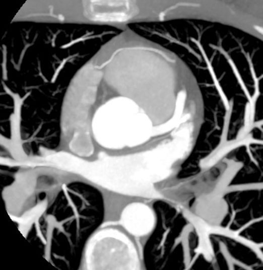 AuntMinnie.com (@auntminnie) on Twitter photo What's your diagnosis? 19-year-old woman with acute onset of palpitations #radiology <a href="/PennMedicine/">Penn Medicine</a> buff.ly/wNwSBIN What's your diagnosis? 19-year-old woman with acute onset of palpitations #radiology <a href="/PennMedicine/">Penn Medicine</a> buff.ly/wNwSBIN