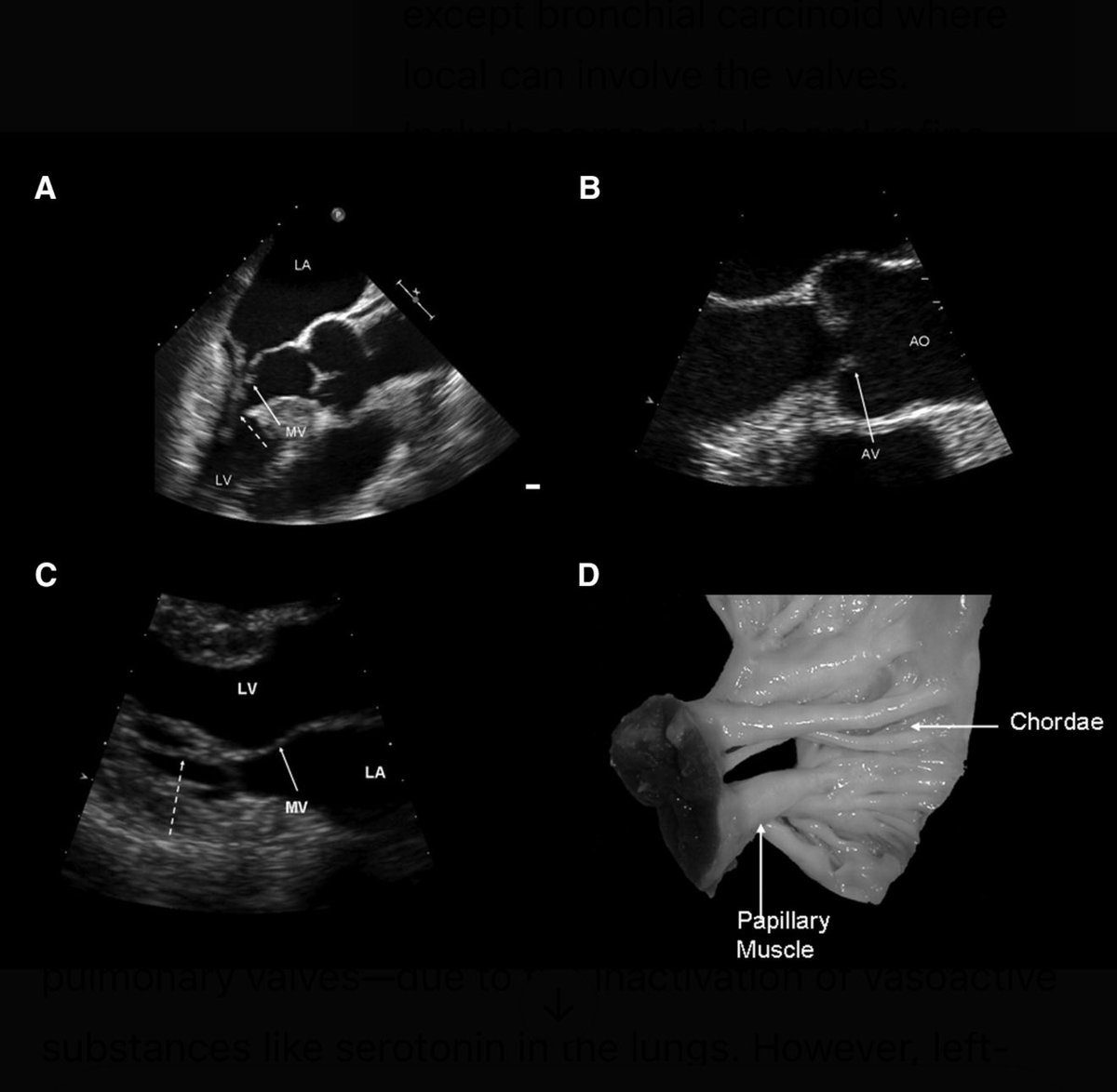 In carcinoid heart disease, left-sided valve involvement is rare because serotonin is usually inactivated in the lungs. But if there's a bronchial carcinoid (originating in the lungs), it can bypass this filter and directly affect left heart valves — even without metastasis. A