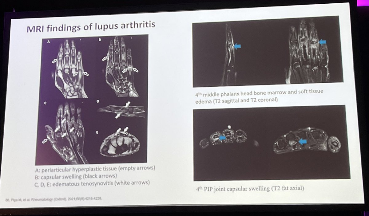 Roxana González (@roxosler) on Twitter photo Imaging (US & MRI) uncovers hidden inflammation in lupus arthritis. Subclinical synovitis is common, even in the absence of clinical arthritis. Both modalities detect structural changes that may reshape treatment decisions. #LUPUS2025 Imaging (US & MRI) uncovers hidden inflammation in lupus arthritis. Subclinical synovitis is common, even in the absence of clinical arthritis. Both modalities detect structural changes that may reshape treatment decisions. #LUPUS2025