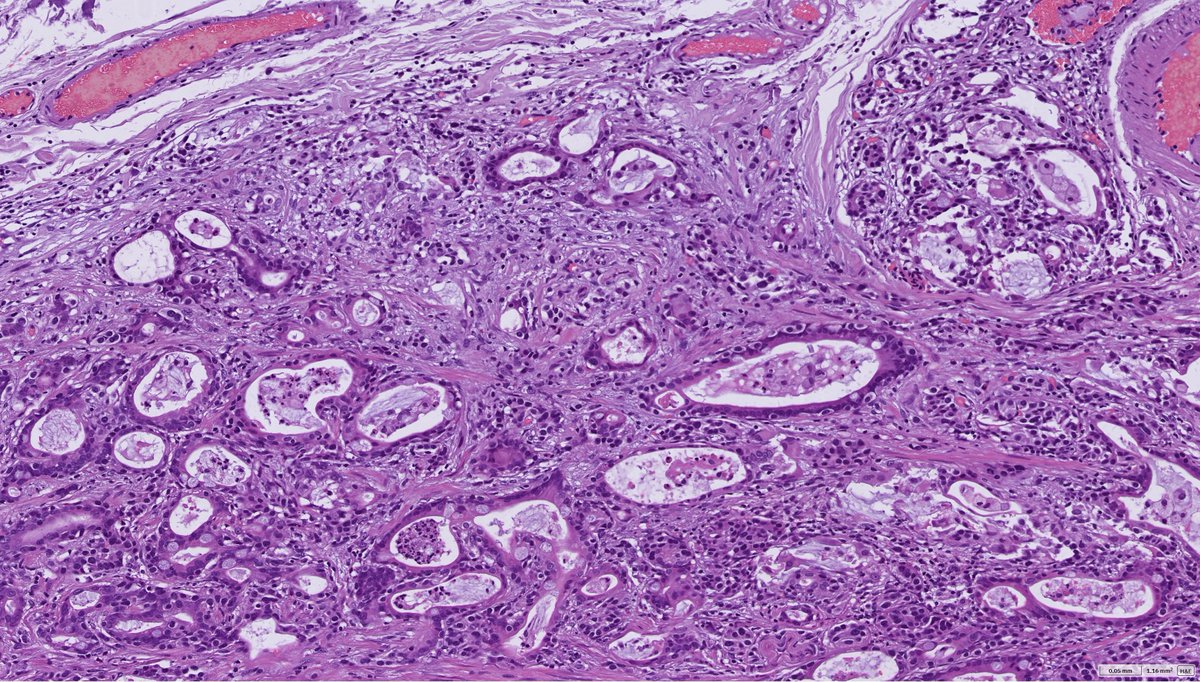Extremely well-differentiated adenocarcinoma with a neuroendocrine tumor in the stomach. Intestinal metaplasia-like glands of the adenocarcinoma.
#GIpath #NET #MINEN