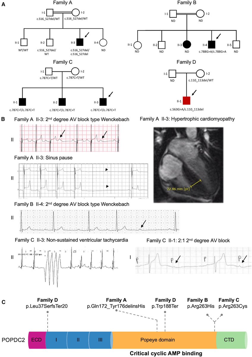 DiseaseGenes (@diseasegenes) on Twitter photo RT <a href="/FranMartinezGr/">Francisco MartĂnez</a>: Bi-allelic variants in POPDC2 cause an autosomal recessive syndrome presenting with cardiac conduction defects and hypertrophic cardiomyopathy #RareDisease #Genetics #morbidgene cell.com/ajhg/fulltext/… RT <a href="/FranMartinezGr/">Francisco MartĂnez</a>: Bi-allelic variants in POPDC2 cause an autosomal recessive syndrome presenting with cardiac conduction defects and hypertrophic cardiomyopathy #RareDisease #Genetics #morbidgene cell.com/ajhg/fulltext/…