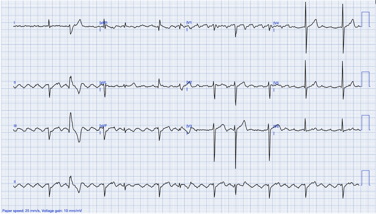Stephen W. Smith (@smithecgblog) on Twitter photo And now for something completely different (a very difficult electrophysiology case)
hqmeded-ecg.blogspot.com/2025/05/and-no…
<a href="/willyhfrick/">Willy Frick</a> And now for something completely different (a very difficult electrophysiology case)
hqmeded-ecg.blogspot.com/2025/05/and-no…
<a href="/willyhfrick/">Willy Frick</a>