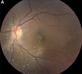 A 29 year old comes in with 2 weeks of blurred vision in the left eye

Her acuity is L 20/100, R 20/20, with a left relative afferent pupillary defect

As you’re running through the differential of optic neuritis, you see this on fundoscopy

What is this? What do you do next? 1/