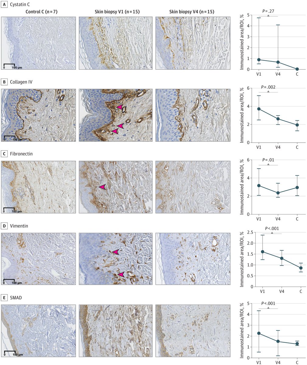 This phase 2a clinical trial found that high-dose N-acetylcysteine (NAC) was safe, well tolerated, and reduced disease-associated biomarkers in patients with hereditary cystatin C amyloid angiopathy (HCCAA). ja.ma/4kcDJMq