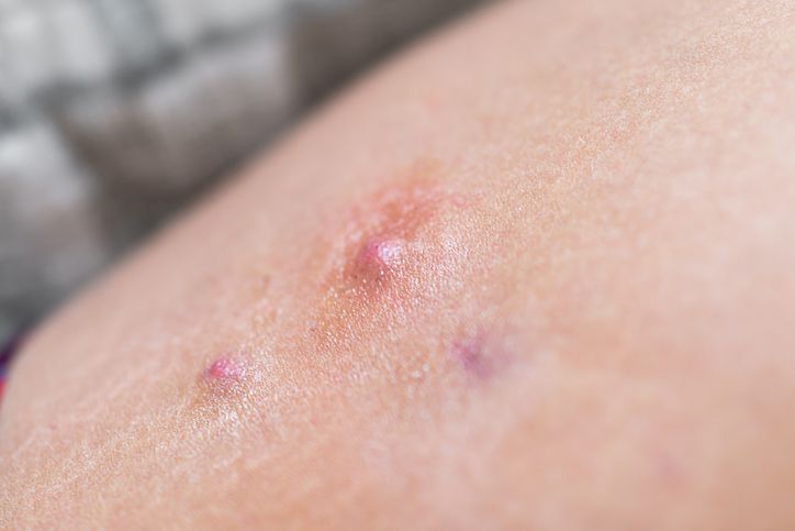 mydocwire's tweet image. 🧬 Exciting news in dermatology! Upadacitinib shows promise for treating hidradenitis suppurativa.
📊 In a phase 2 trial, 38.3% achieved HiSCR50 at week 12 vs. 25% with placebo.
🔗 buff.ly/BEW2lJZ
#HidradenitisSuppurativa #Upadacitinib #Dermatology #ClinicalTrials