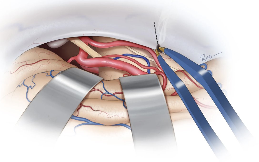neurosurgatlas's tweet photo. During the expansion of the subtemporal approach towards the ventrolateral brainstem, which nerve should be carefully dissected from its dural canal up to its entrance in the cavernous sinus?
#Neurosurgery #CranialBaseSurgery #SubtemporalCraniotomy #Neuroanatomy https://t.co/HEYZcalB8a