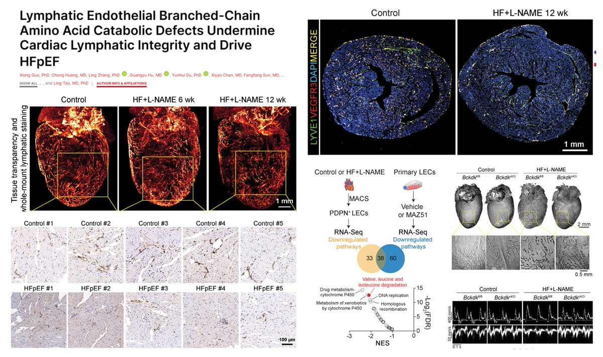 HaoYin20's tweet photo. Heart #Lymphangiogenesis

Cardiac lymphatic vessel bridges defect #BranchedChainAminoAcid Catabolism with #HeartFailure HFpEF

Rarefaction (~50%⏬) of heart lymphatic vasculature in 👤🐭HFpEF (Hypertension L-NAME + Obesity #HighFatdiet 12 wk)

AAV9-VEGFC in 🐭HFpEF▶️
⏫Diastolic function (⏬E/A E/e' LVEDP)
⏬cardiomyocyte size fibrosis CD68 Mφ
⏬lung congestion

Prox1+ #LymphaticEndothelialCell KO of BCKDK, kinase inactivating BCKDHA (rate-limiting enzyme of BCAA degradation) restored 
#Lymphangiogenesis 
Diastolic function 
🫀pathology 
in 🐭HFpEF

Hyperactive Src-mediated lysosomal degradation of VEGFR3 underlies lymphangiogenic defects in vitro caused by BCAA catabolism deficiency (BCKDK OE)

@CircAHA 2025
https://t.co/q72bNdM7gH