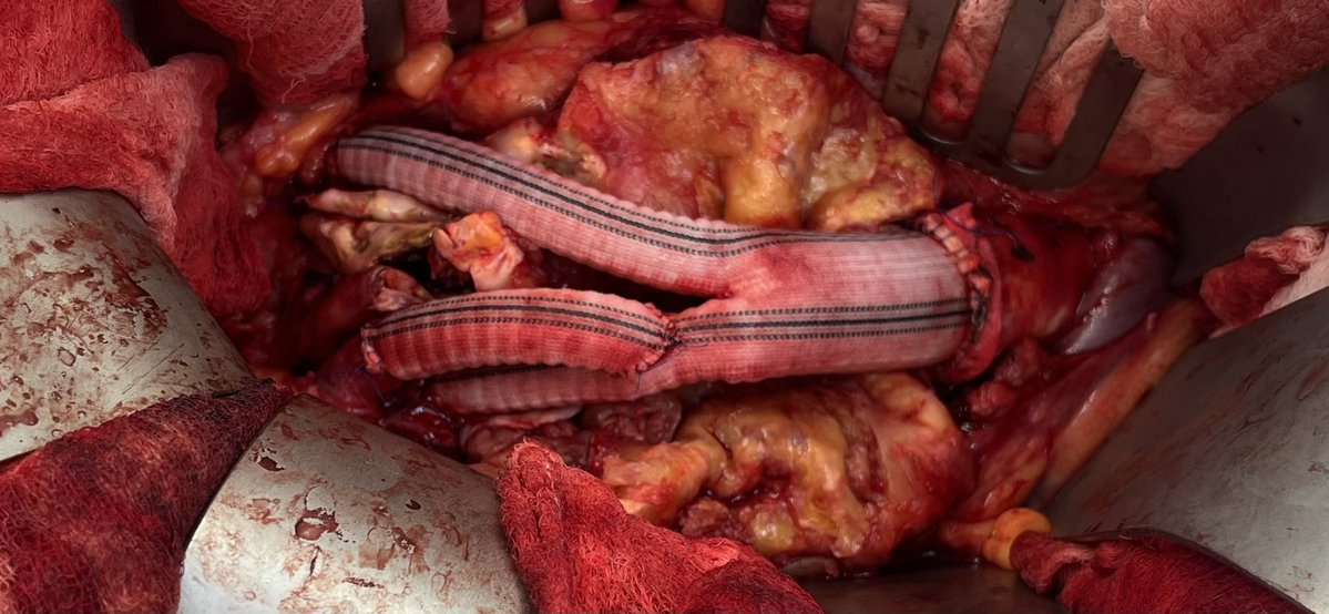 Mitchell Dyer (@mitchelldyermd) on Twitter photo Open aortic surgery alive and well at <a href="/MCWVascSurg/">MCW Vascular and Endovascular Surgery</a>. Aortoiliac aneurysms with prior Type A dissection extending to iliacs. Aorto-R EIA (internal had aneurysm so ligated)-L IIA with jump to EIA. Open aortic surgery alive and well at <a href="/MCWVascSurg/">MCW Vascular and Endovascular Surgery</a>. Aortoiliac aneurysms with prior Type A dissection extending to iliacs. Aorto-R EIA (internal had aneurysm so ligated)-L IIA with jump to EIA.