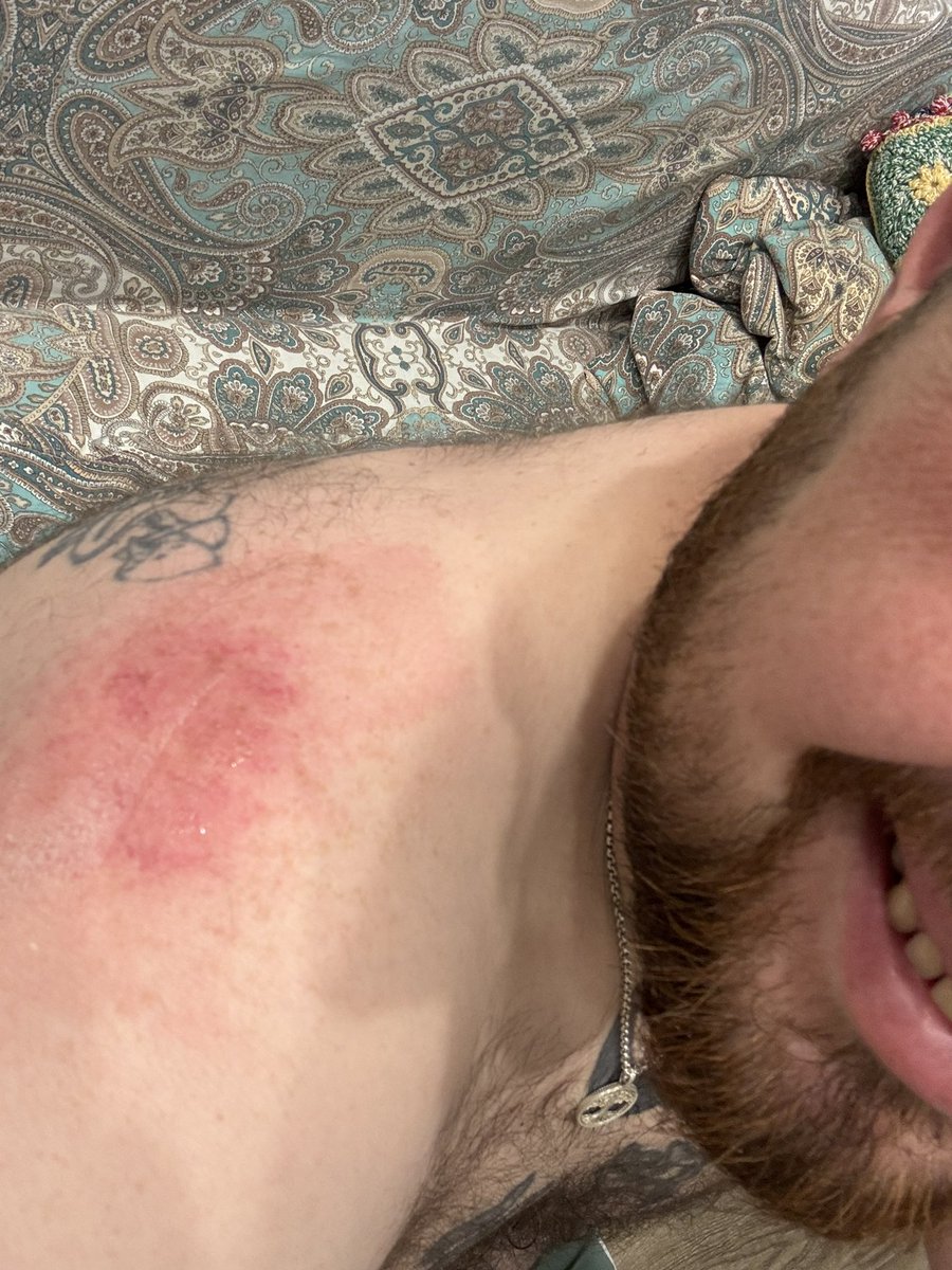 С первой уборкой в этом сезоне меня , разложился об асфальт почти возле самого дома ,в целом ерунда думал в темноте  что вообще до костей стер 😅