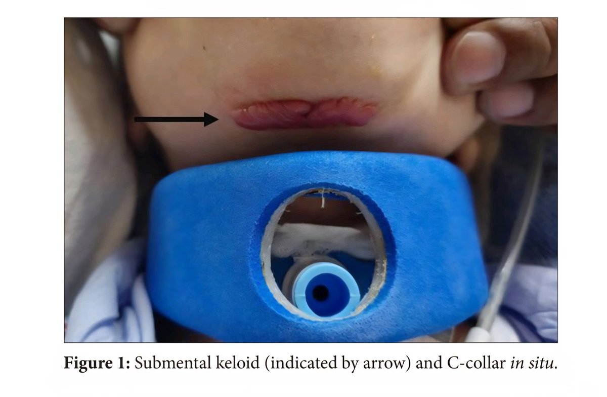 No doubt, cervical collars are protective, but it's important to monitor for pressure sores-especially with semi-rigid and rigid collars, and particularly in children.