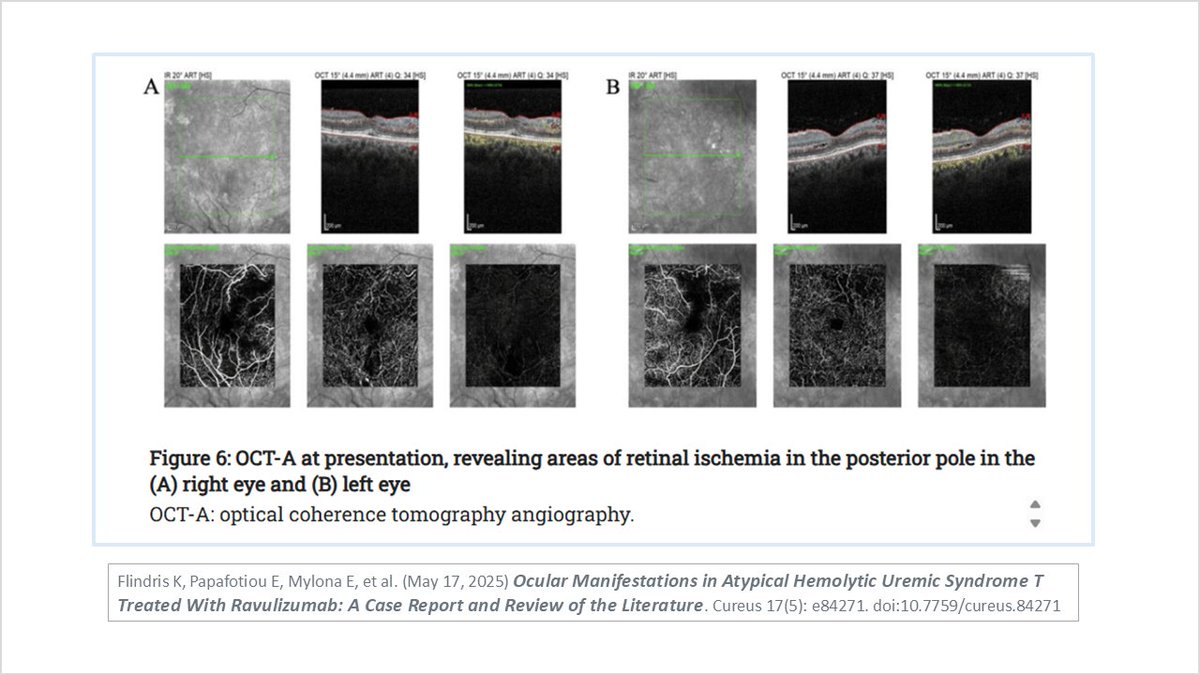 Young man with a history of #aHUS (CFH R1-R3) had retinal detachment &amp; #ischemia found during routine #ophthalmological exam, part of a systemic review following a hypertensive crisis during a respiratory infection. assets.cureus.com/uploads/case_r… #extrarenal