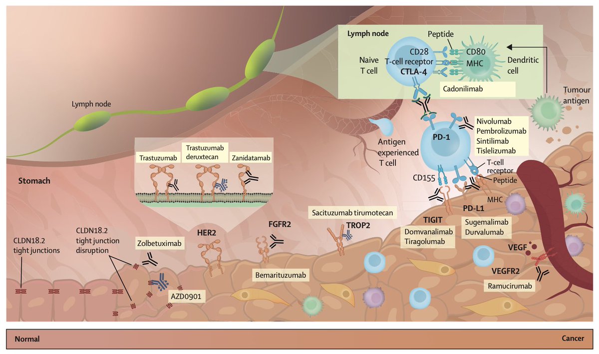 🚨 Gastric cancer: an ongoing global challenge.

GC causes &gt;650K deaths/year. Rising early-onset cases highlight urgent need for better detection &amp; therapy.

Key trends:
🔹 H. pylori, diet, genetics.
🔹 D2 surgery + chemo.
🔹 Immunotherapy &amp; targeted agents.
🔹 Precision oncology