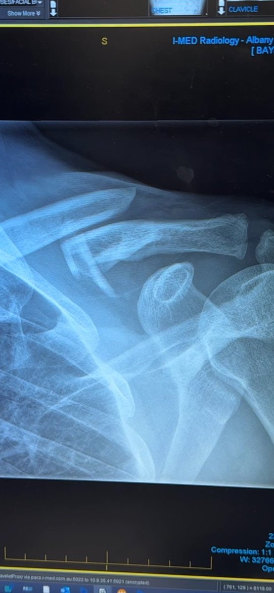 AshBaynes's tweet photo. Was planning to start seeding this weekend 5 fractures on the collar bone I’m grateful for Albany Health Campus for being awesome and patching me up beginning last week, has been a bit difficult asking for outside help seems challenging. https://t.co/WVrzgCQ66W