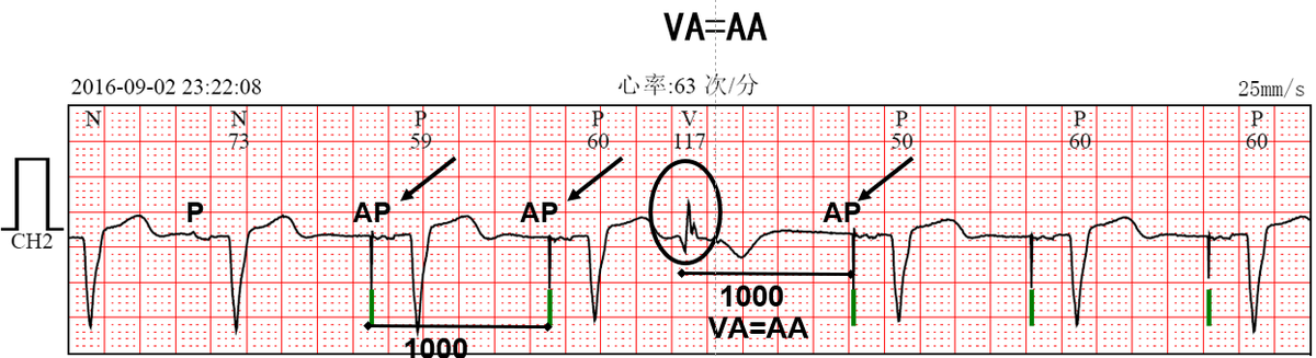 The unique timing rules of Biotronik pacemakers.