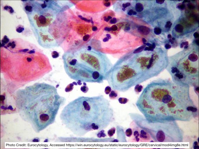 Gyn PAP Smear in 27 y/o F 

 What is ⬇️ and what is the next step? 🤔 

Tip: Tony 🐯 

#pathx
