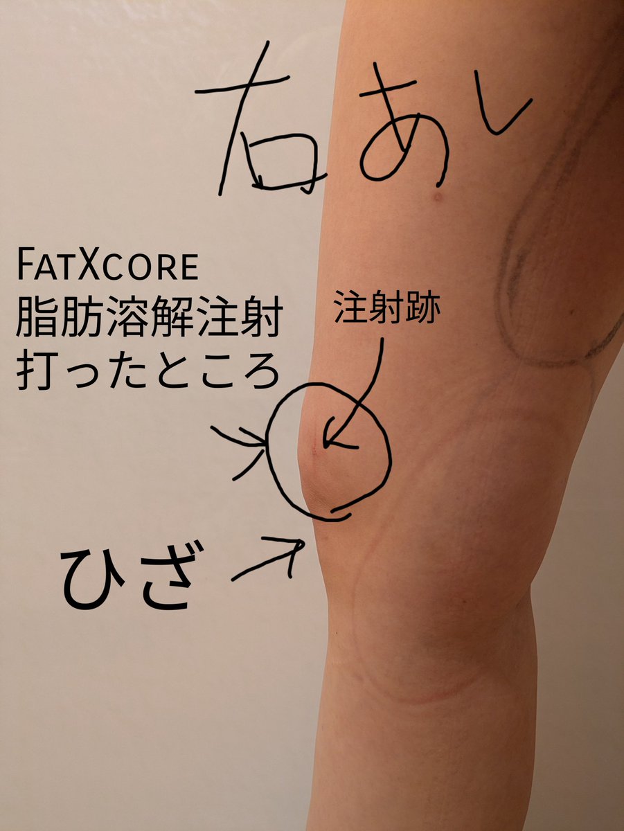787choco's tweet photo. その後すぐに医師の先生が来て注射位置を確認、膝の肉をつまんで注入。正直全然痛くなかった！注入後30分くらいから注入したところが熱を帯びてきて押すとちょっと痛い？ってくらいになった。
⇩施術後2時間後の写真。ひざの上が膨らんでもう１個膝できた笑 https://t.co/Zhv1GK8bmc