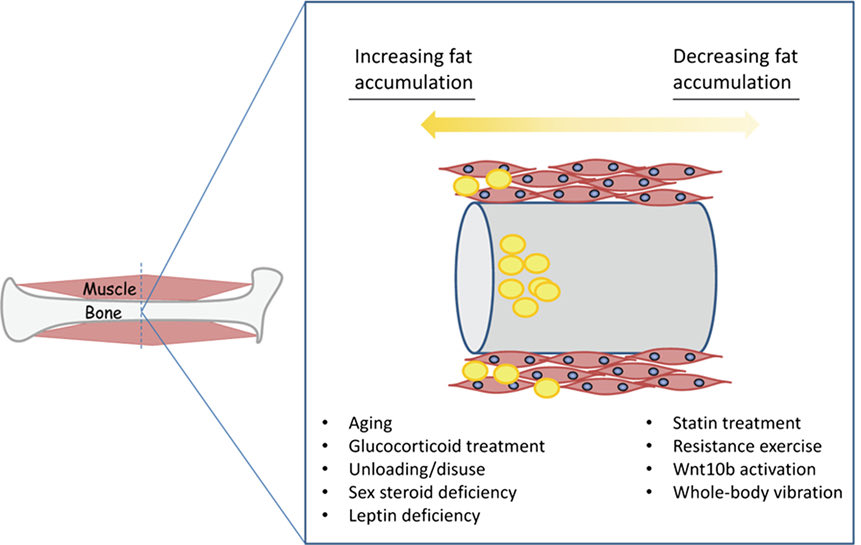 Fatty Infiltration of Skeletal Muscle and Bone

Factors favouring the accumulation of fat (yellow) in muscle and bone versus factors that can prevent or possibly reverse fatty deposition in muscle and bone👇🏼

#muscle #bone #IMAT #function

frontiersin.org/journals/endoc…